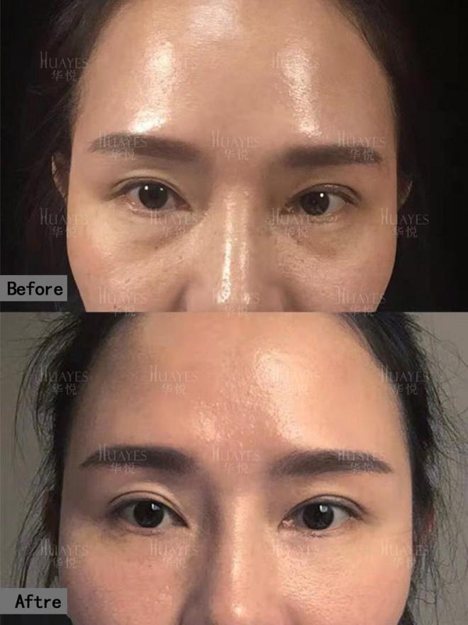 眼部青春光彩一键重启眼部青春魅力z6尊龙网站华悦白孝梅院长：重塑